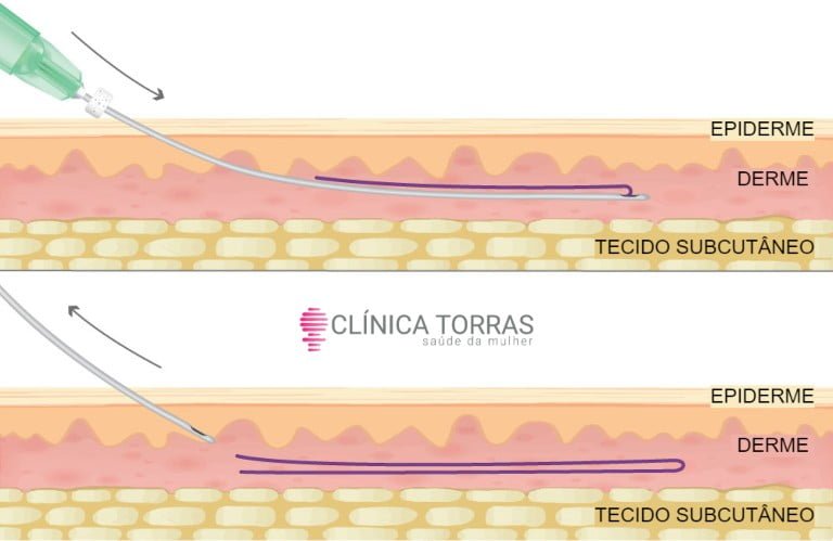 fios de pdo intimo preço