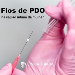 fios PDO vaginal intimo