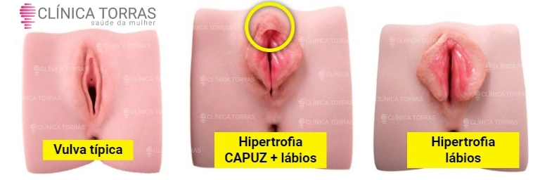 capuzplastia