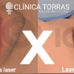 laser íntimo e ninfoplastia a laser