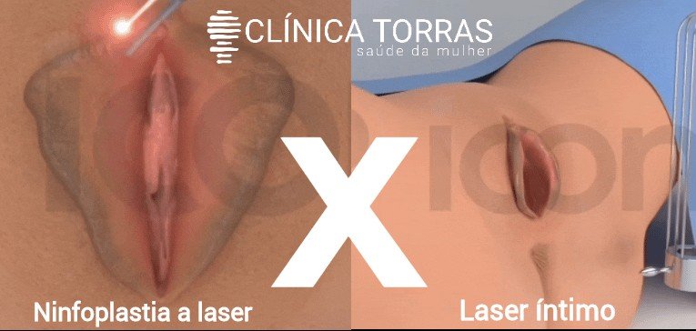 laser íntimo e ninfoplastia a laser