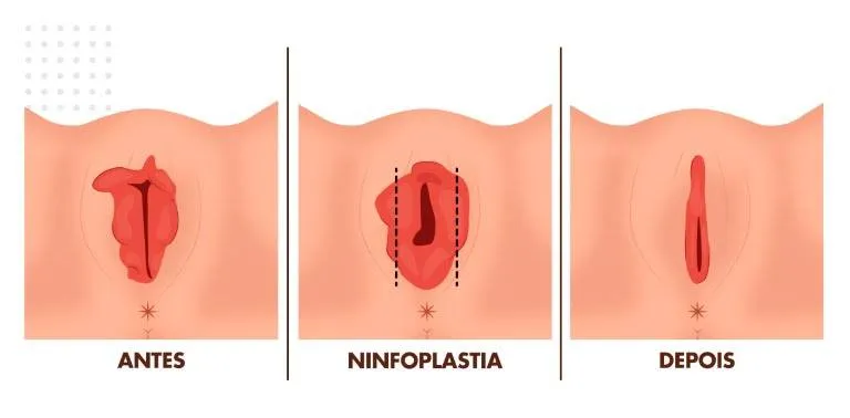 ninfoplastia