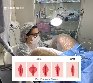 ninfoplastia antes e depois