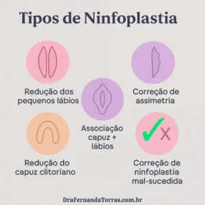 tipos de ninfoplastia