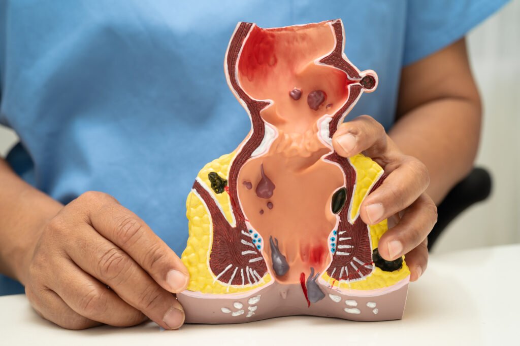 asian doctor with rectum and hemorrhoid human anat 2025 02 25 23 28 03 utc
