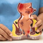 asian doctor with rectum and hemorrhoid human anat 2025 02 25 23 28 03 utc