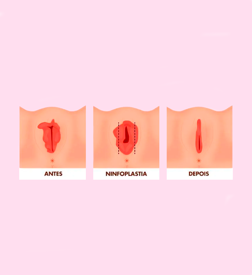 Ninfoplastia