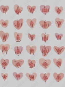 Ninfoplastia a laser