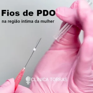 Fios de PDO na região íntima