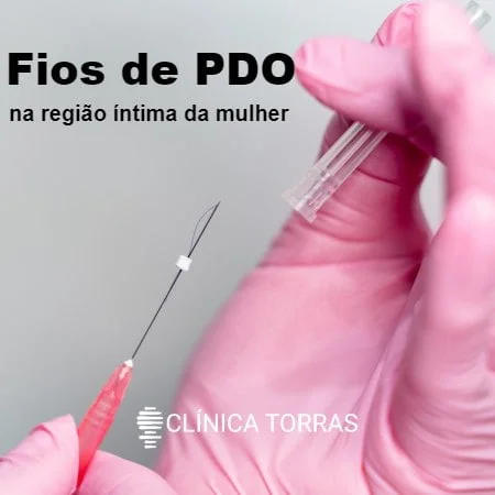 Fios de PDO na região íntima