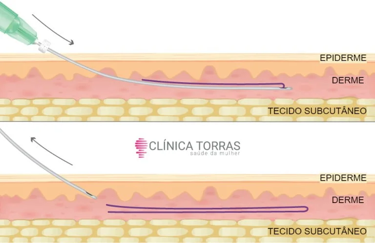 O preço dos Fios de PDO na região íntima pode variar conforme a necessidade de cada mulher.