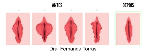 antes e depois da labioplastia