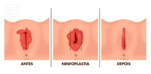 Labioplastia