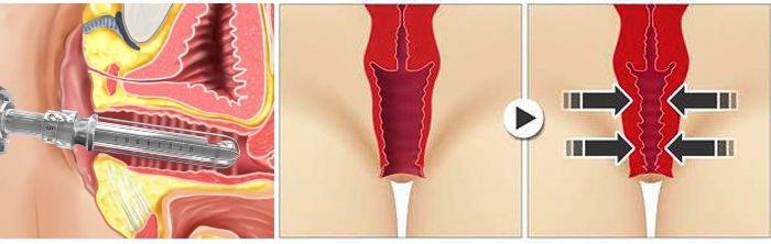 Laser Vaginal