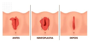 Ninfoplastia