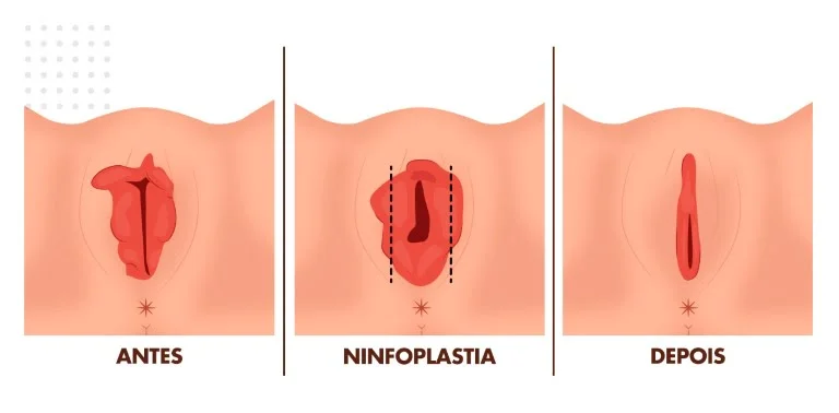 Ninfoplastia