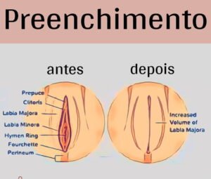 Antes e Depois do Preenchimento Íntimo