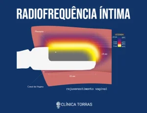 Radiofrequência Ginecológica