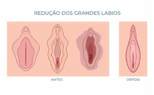 Redução dos grandes lábios: cirurgia íntima para diminuir os lábios
